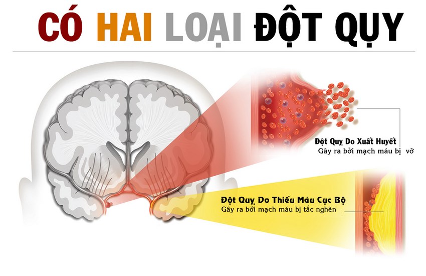 Đột Quỵ có hai dạng cần biết